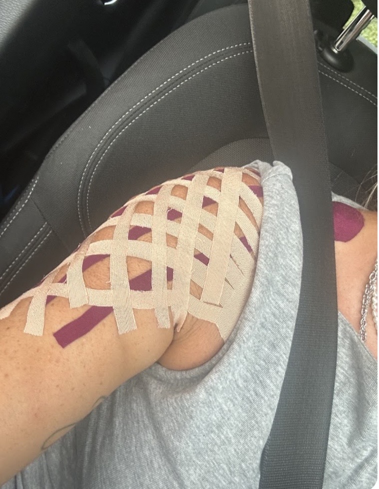 Kinesio-Taping am Oberarm aus einer Patientenbewertung